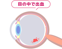 目の中で出血したイメージ図