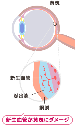 新生血管が黄斑にダメージを与えるイメージ図